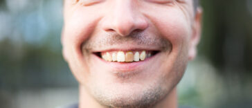Dead Tooth