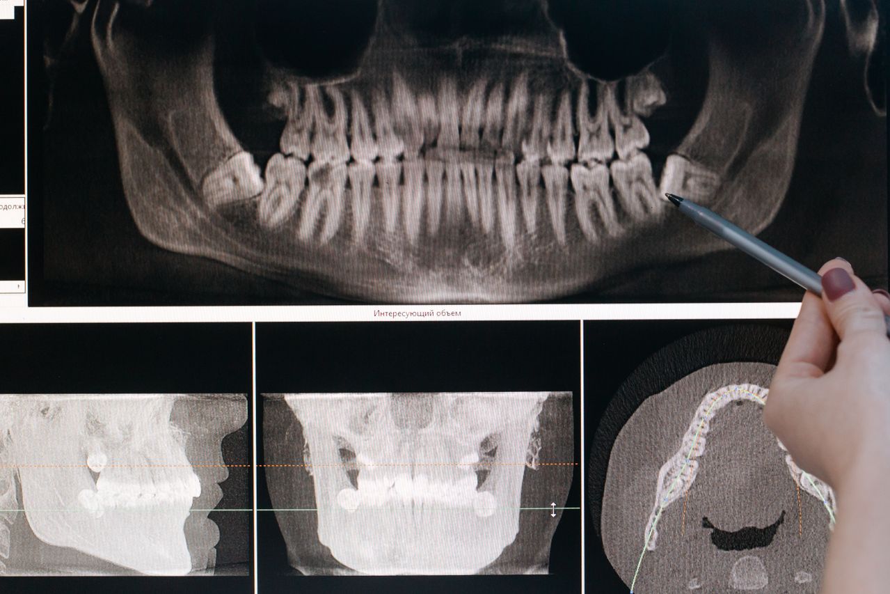 Dentist using a pen to point out impacted wisdom teeth and structural decay on a digital panoramic dental X-ray screen