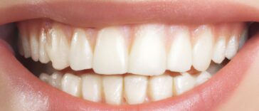 what does a cavity look like​