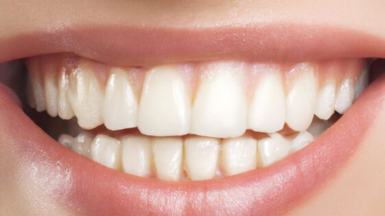 what does a cavity look like​